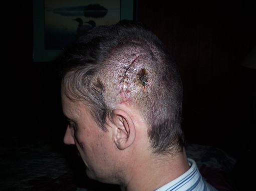 Jens' head 3 days after implant removal operation on Feb 10 2010